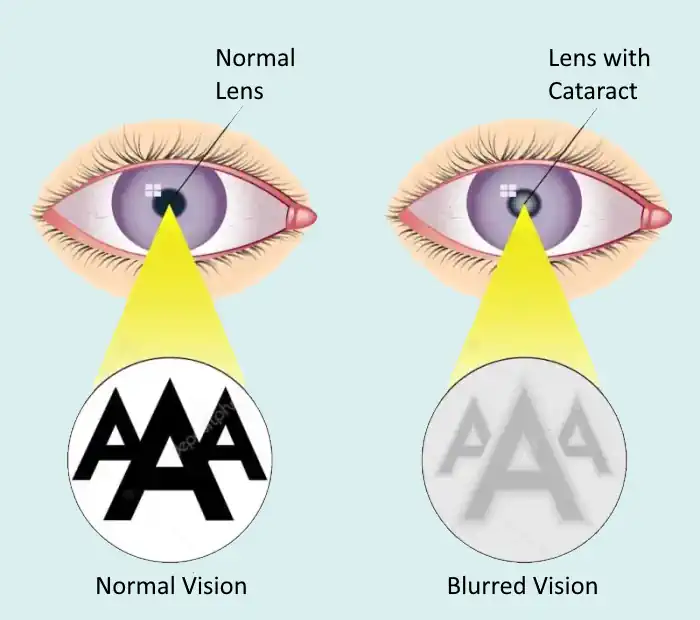 Cataract Visualization